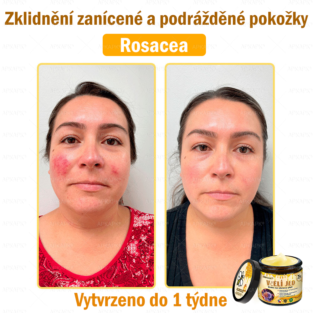😋😋Dermatologicky a klinicky testováno👩‍⚕️APKAPK®Bee Venom Krém na obnovení pleti🐝 pomáhá při léčbě kožních problémů, jako jsou: vrásky, jizvy, pigmentové skvrny, strie, akné, psoriáza, ekzém, kožní změny, podráždění, záněty a další kožní problémy.