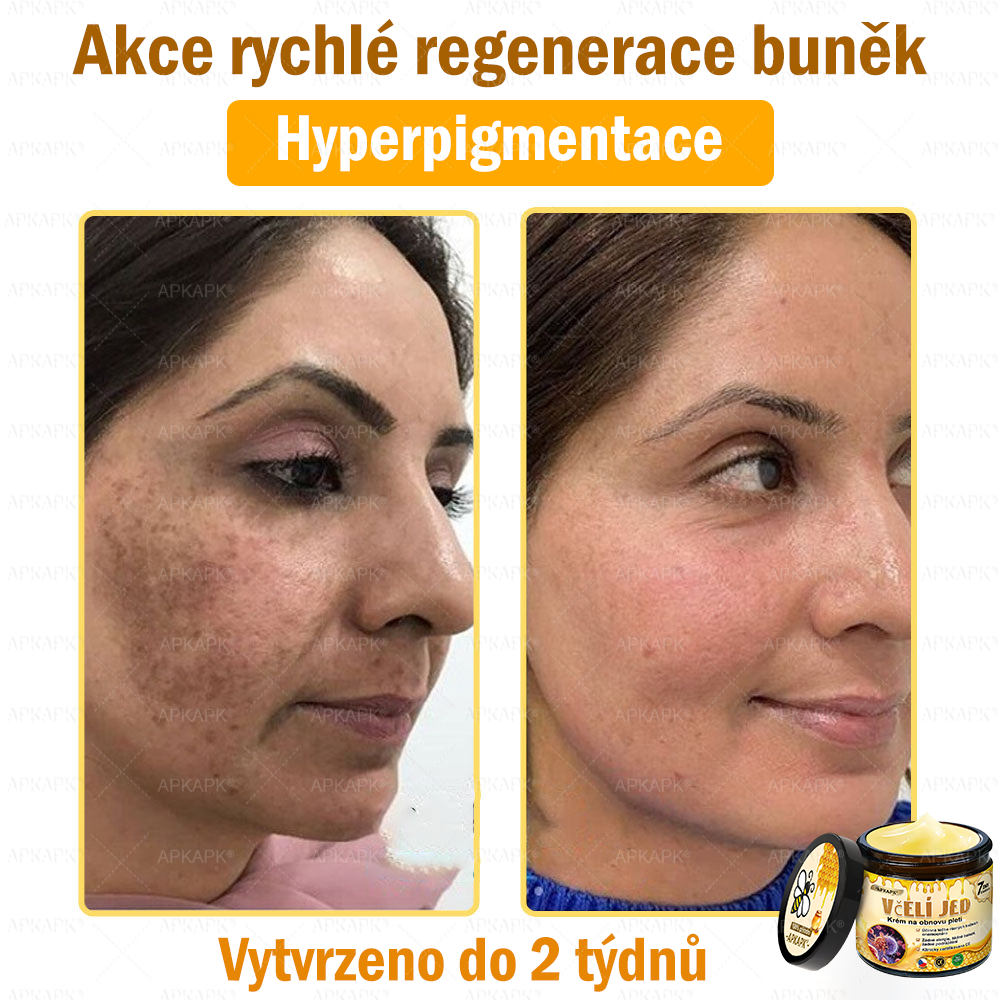 😋😋Dermatologicky a klinicky testováno👩‍⚕️APKAPK®Bee Venom Krém na obnovení pleti🐝 pomáhá při léčbě kožních problémů, jako jsou: vrásky, jizvy, pigmentové skvrny, strie, akné, psoriáza, ekzém, kožní změny, podráždění, záněty a další kožní problémy.